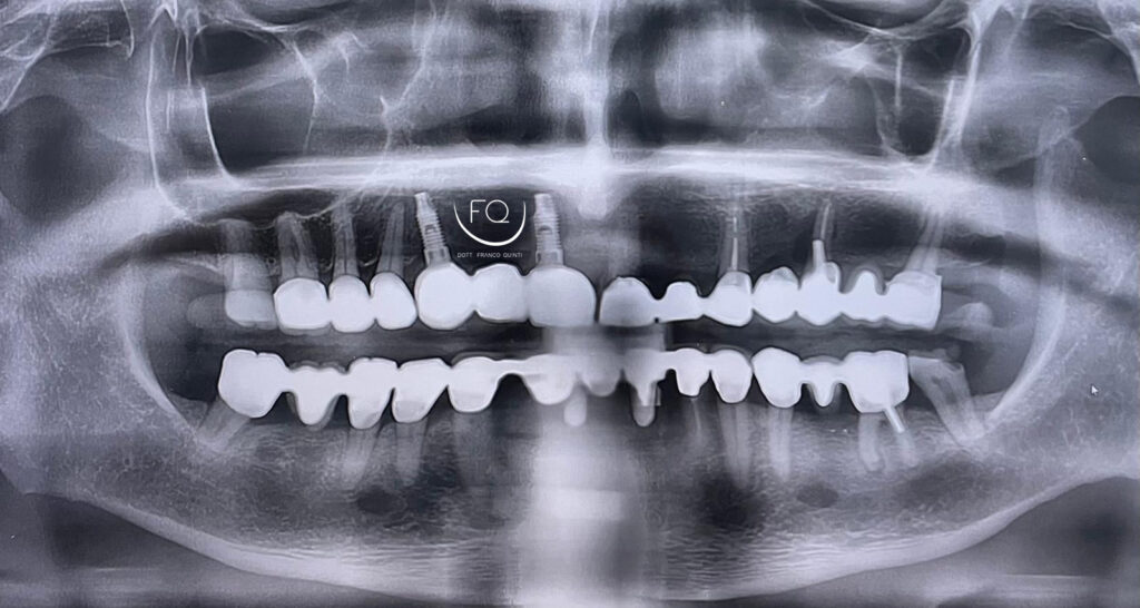 Chirurgia Computer Guidata monolaterale - 1