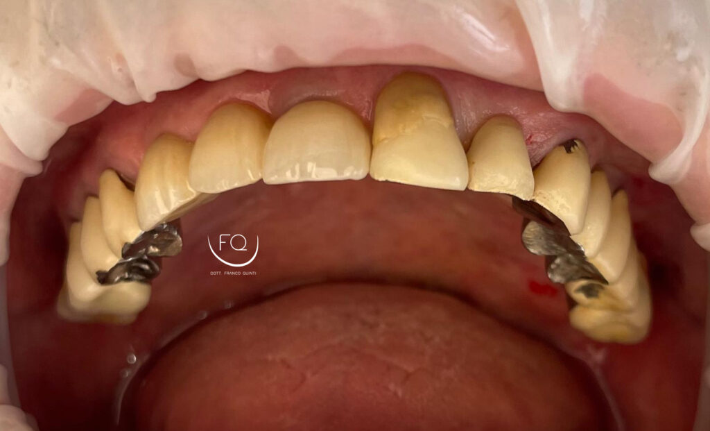 Chirurgia Computer Guidata monolaterale - 2