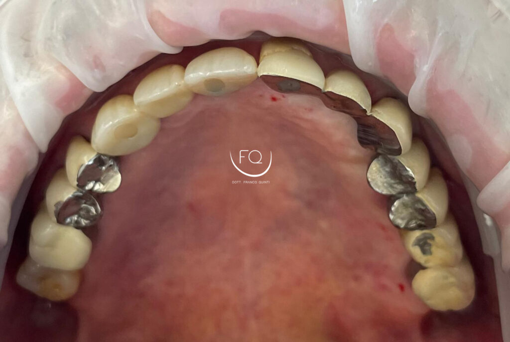 Chirurgia Computer Guidata monolaterale - 3