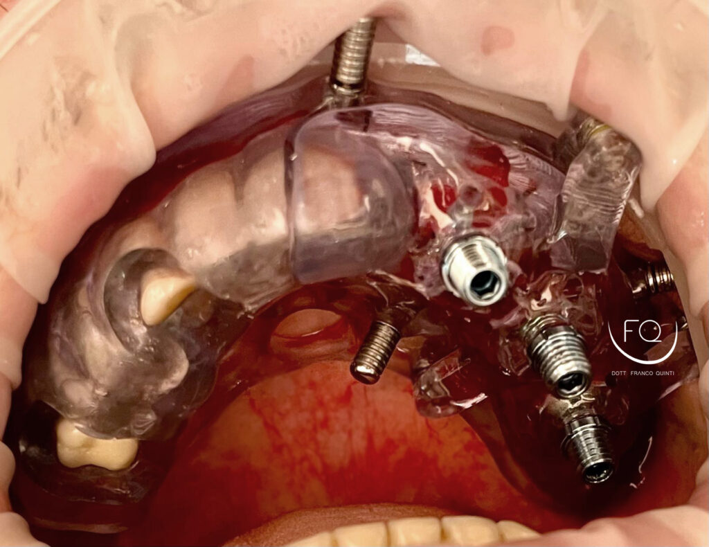 Chirurgia Computer Guidata monolaterale - 4