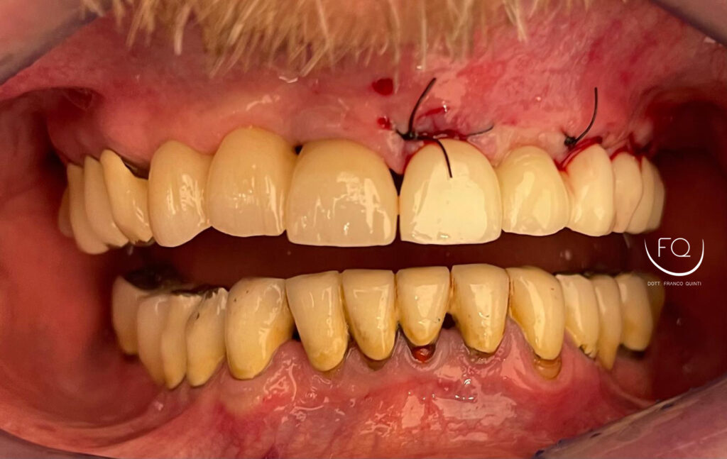 Chirurgia Computer Guidata monolaterale - 5