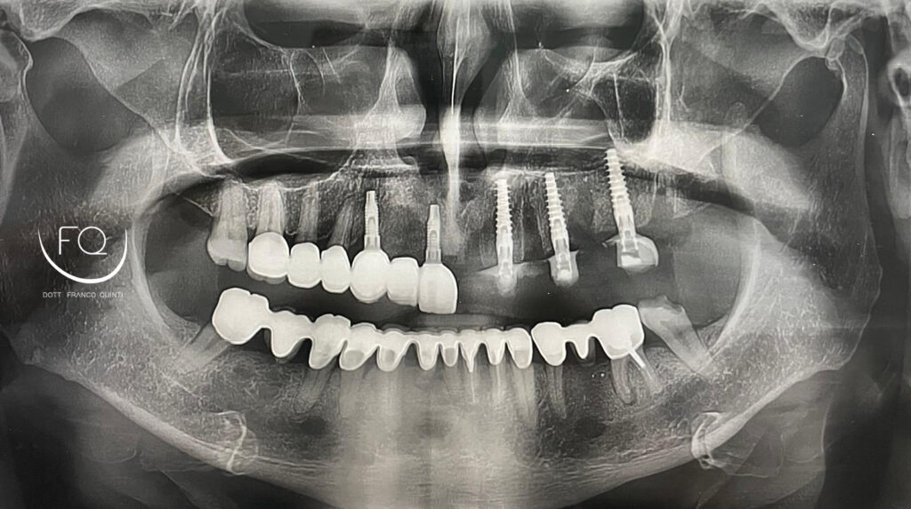 Chirurgia Computer Guidata monolaterale - 6