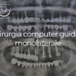 Chirurgia Computer Guidata monolaterale - 28 gennaio