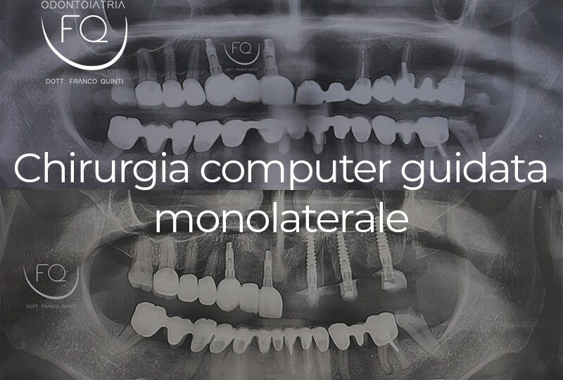 Chirurgia Computer Guidata monolaterale - 28 gennaio