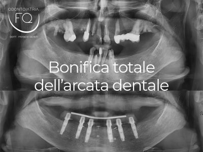 Bonifica totale delle arcate dentali