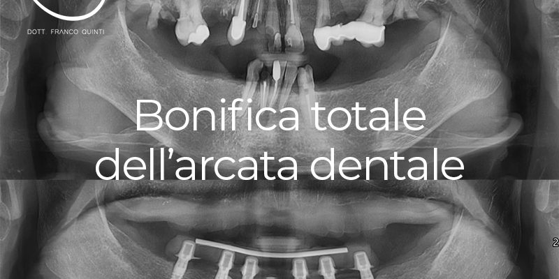 Bonifica totale dell'arcata dentale