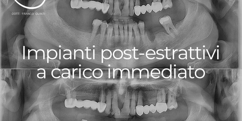 Impianti Post-Estrattivi a carico immediato