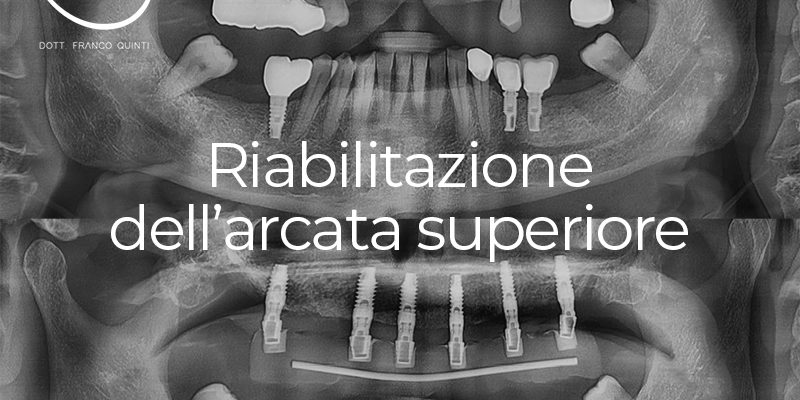 Riabilitazione dell'arcata superiore