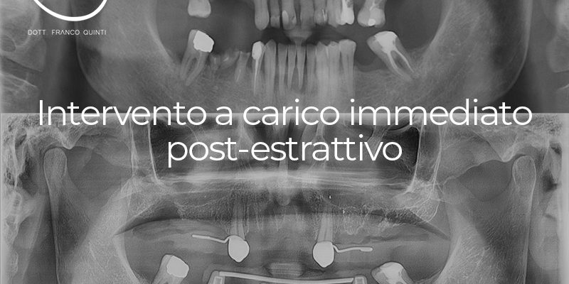 Intervento a carico immediato post-estrattivo