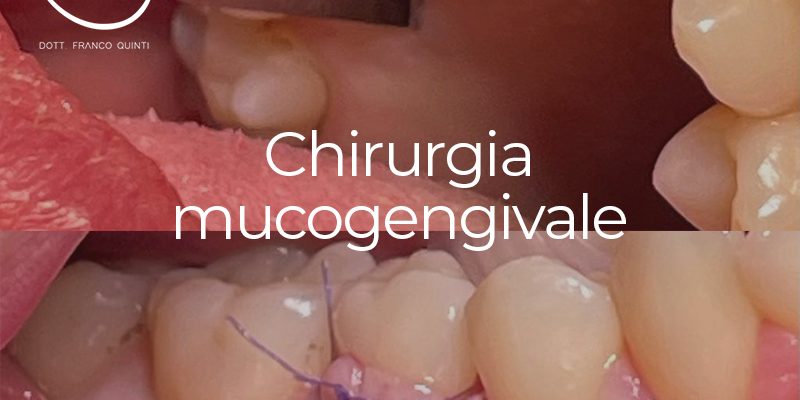 Chirurgia mucogengivale - 13 settembre