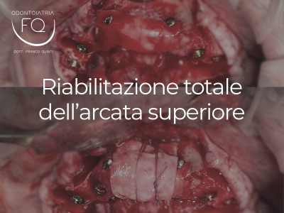 Riabilitazione totale di un’arcata superiore in dentizione terminale