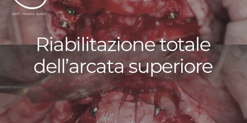 Riabilitazione totale dell'arcata superiore - 23 agosto