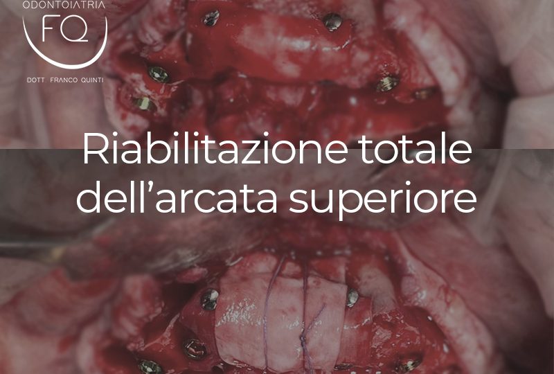 Riabilitazione totale dell'arcata superiore - 23 agosto