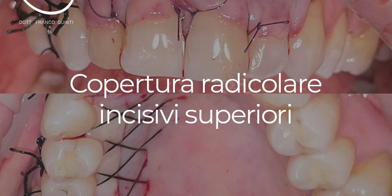 Copertura radicolare incisivi superiori - 22 novembre