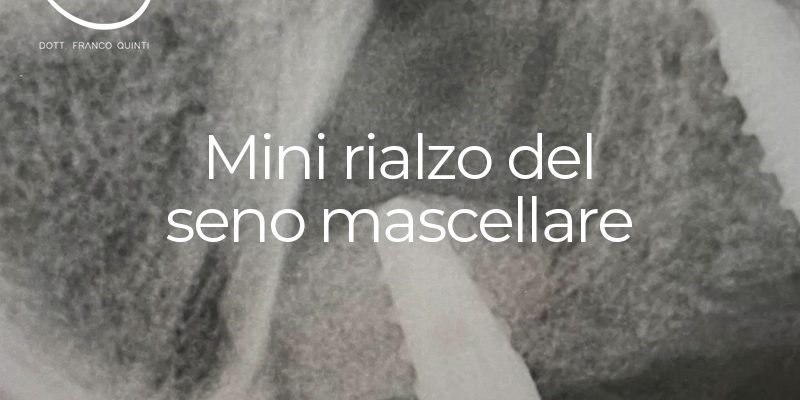 Mini rialzo del seno mascellare - 08 novembre