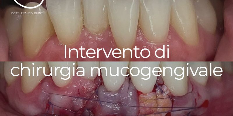 Intervento Chirurgia Mucogengivale - 07 dicembre