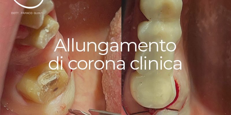 Allungamento corona clinica - 14 febbraio