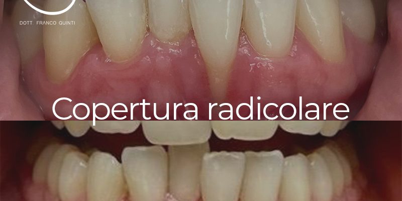 Copertura radicolare - 13 marzo