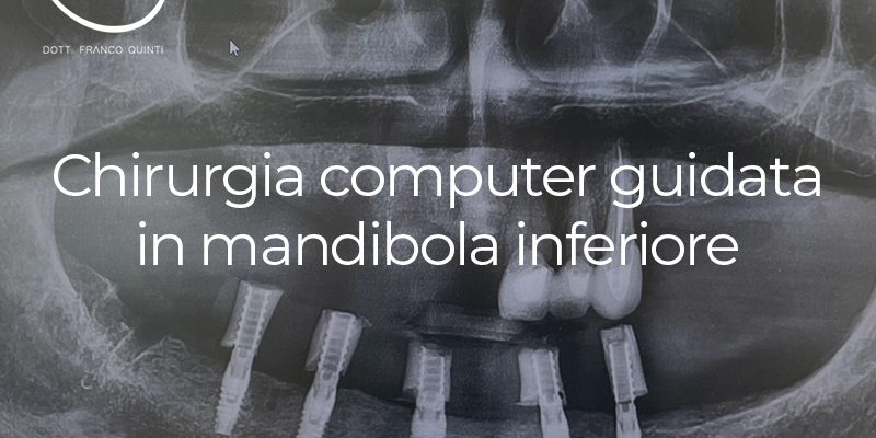 Chirurgia Computer Guidata in mandibola inferiore - 08 maggio