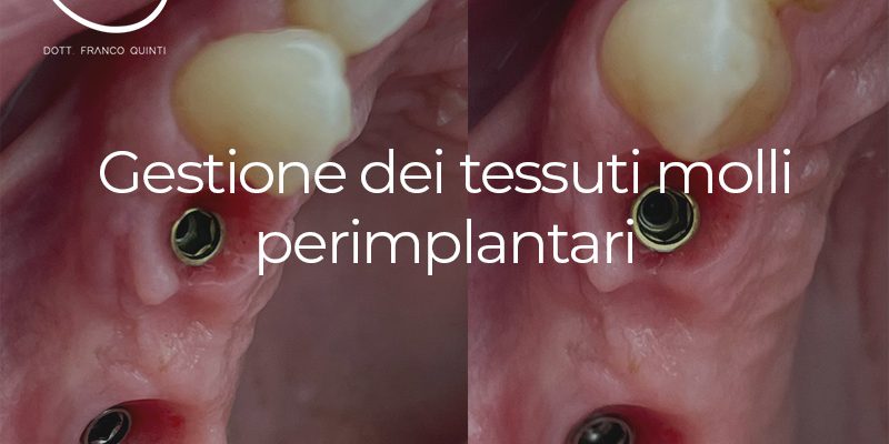 Gestione tessuti molli - 22 maggio