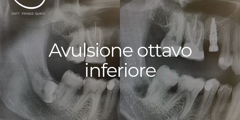 Avulsione dell'ottavo inferiore - 26 giugno