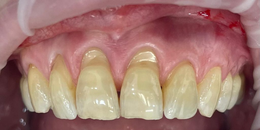 Chirurgia mucogengivale