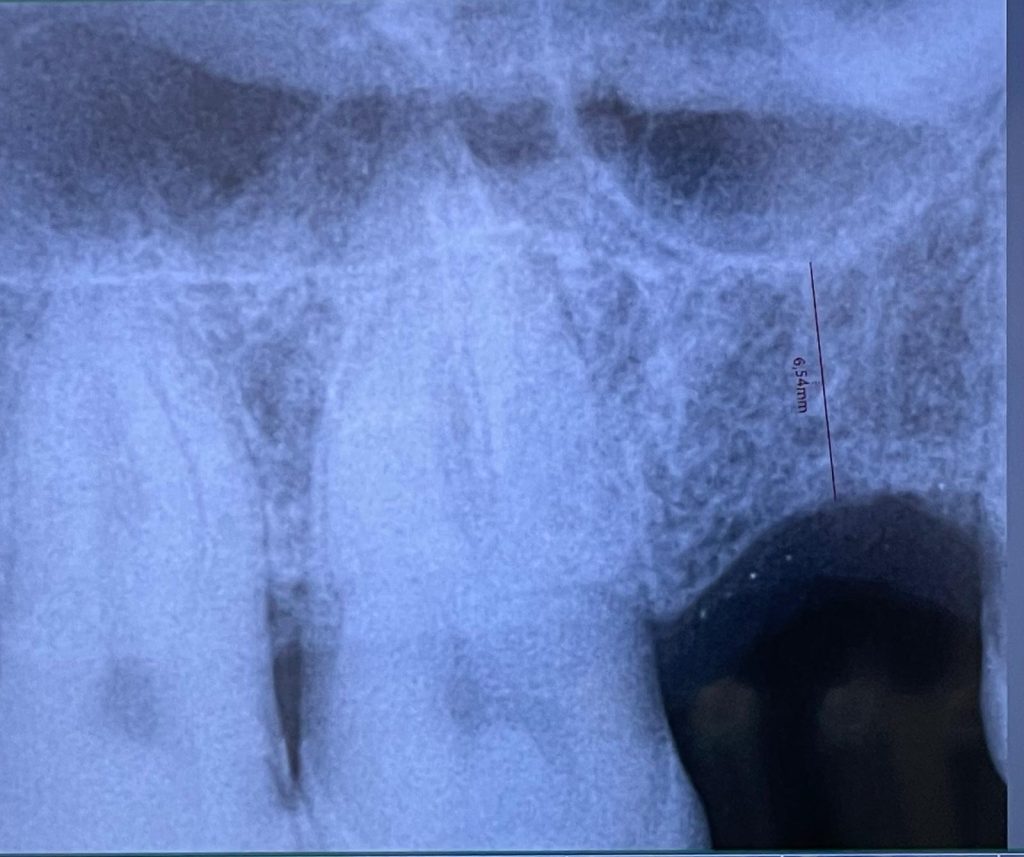 Impianto e mini rialzo di seno - 1