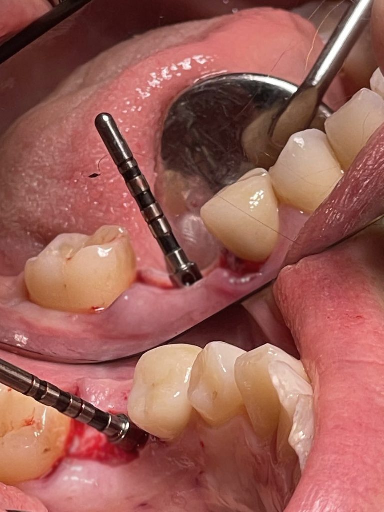 Corretto posizionamento implantare - 1