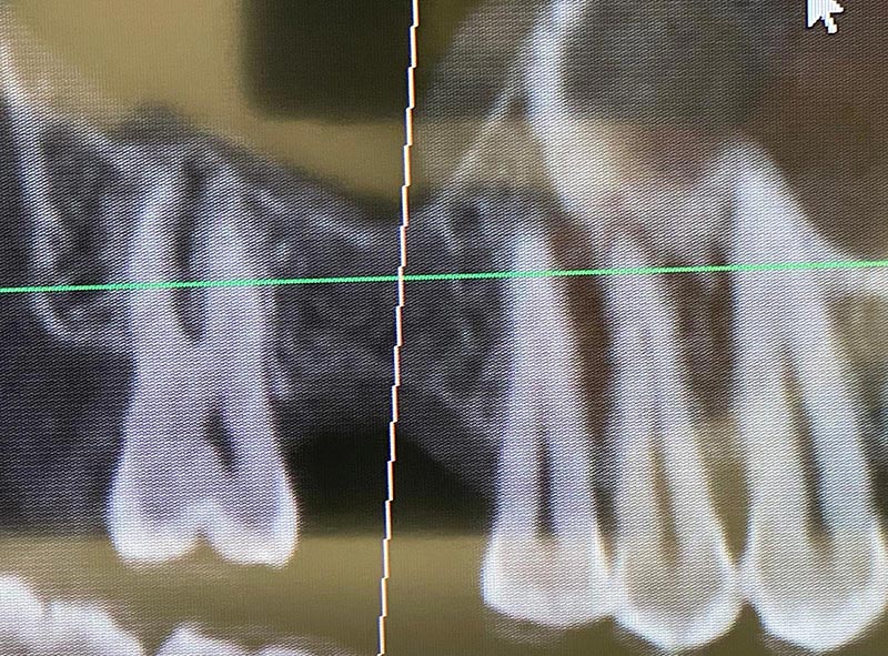 Impianto e mini rialzo di seno - 2