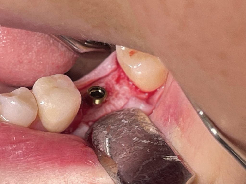 Corretto posizionamento implantare - 2