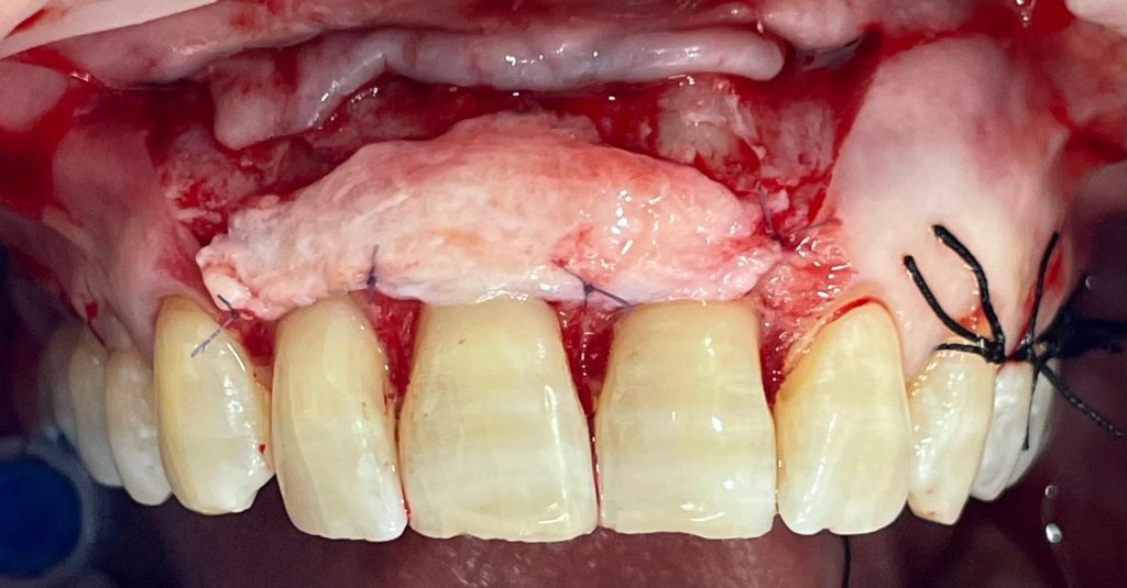 Chirurgia mucogengivale