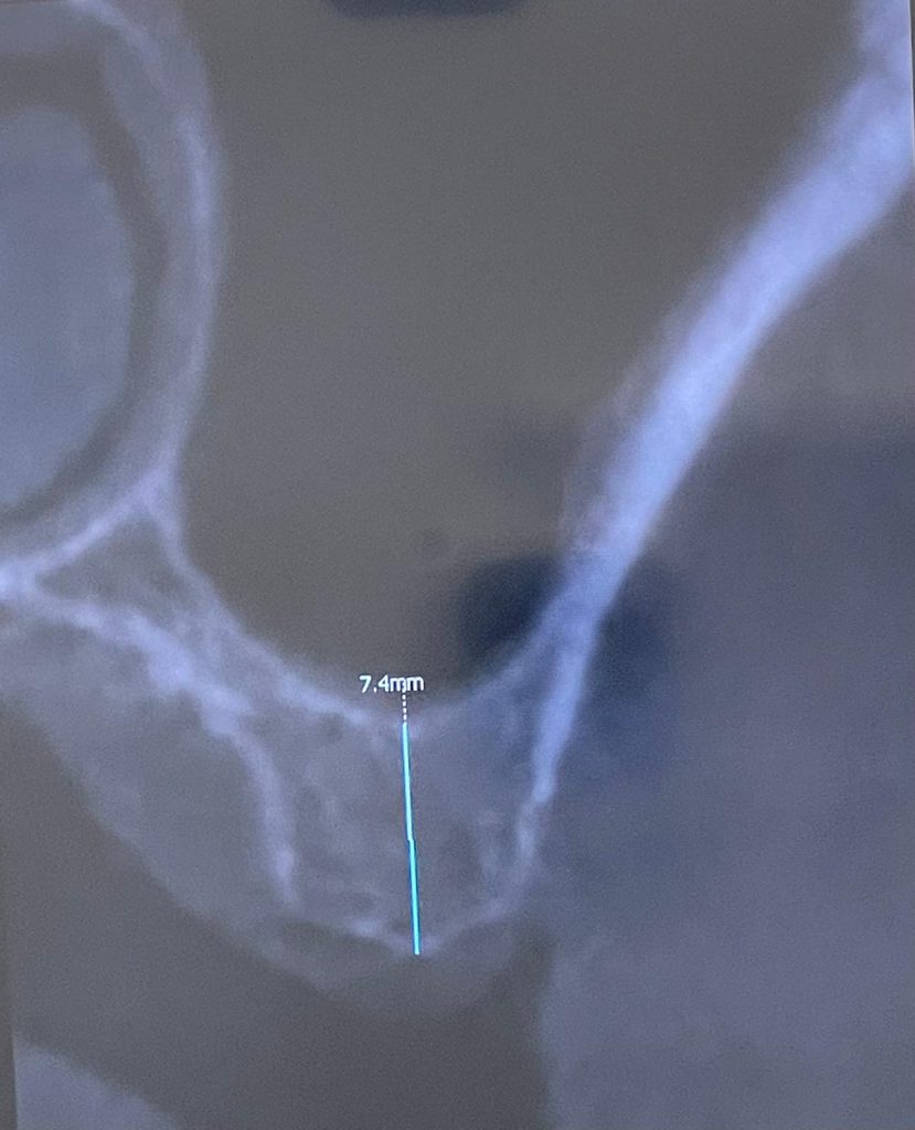 Impianto e mini rialzo di seno - 3