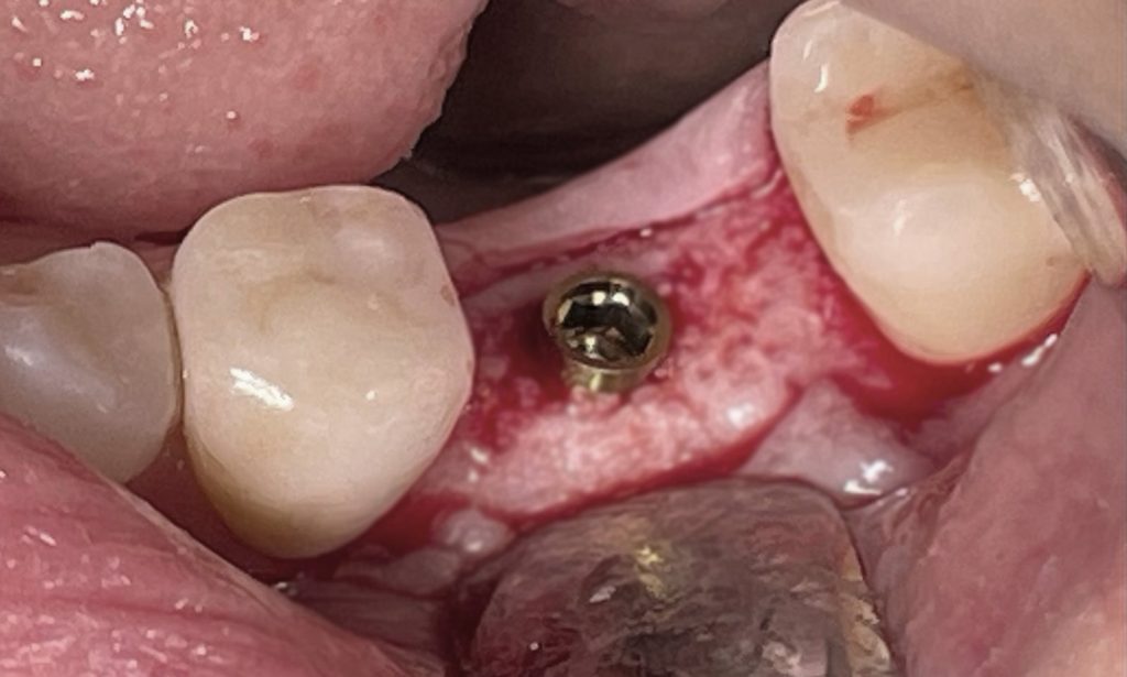 Corretto posizionamento implantare - 3