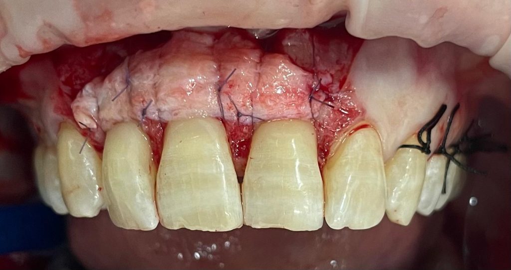 Chirurgia mucogengivale