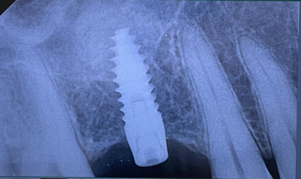 Impianto e mini rialzo di seno - 4