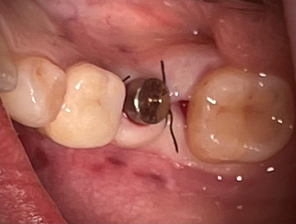 Corretto posizionamento implantare - 4