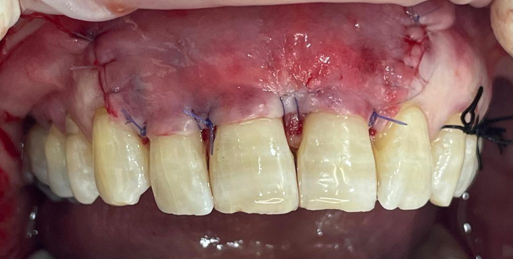 Chirurgia mucogengivale