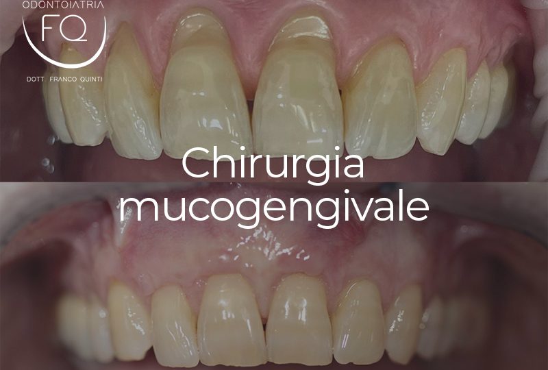 Chirurgia mucogengivale - 10 luglio