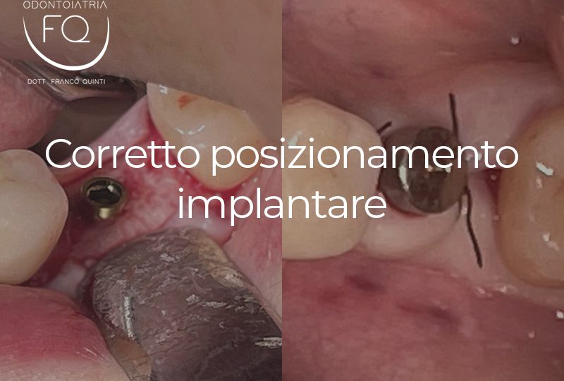 Corretto posizionamento implantare - 19 luglio