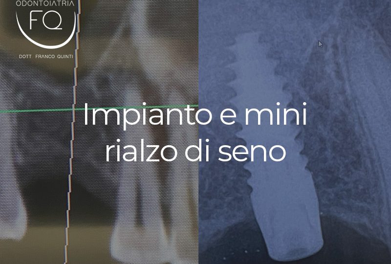 Impianto e mini rialzo di seno - 17 luglio