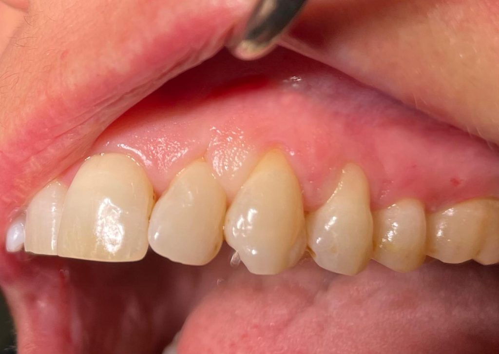 Recessione multipla su denti naturali - 1