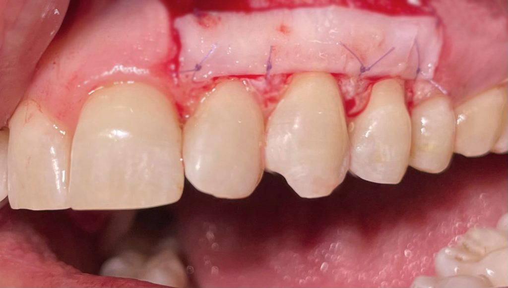 Recessione multipla su denti naturali - 2