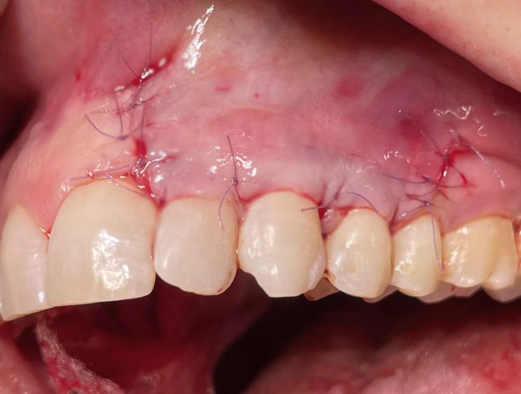 Recessione multipla su denti naturali - 3