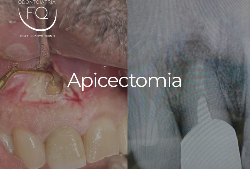 Apicectomia - 28 maggio
