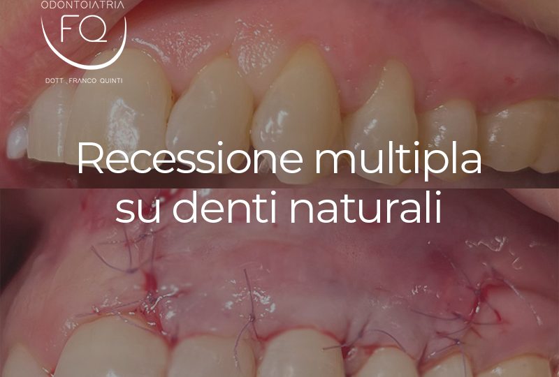 Recessione multipla su denti naturali - 14 maggio