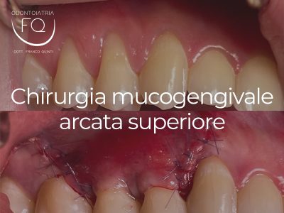 Chirurgia Mucogengivale Arcata Superiore