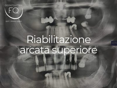Riabilitazione arcata superiore