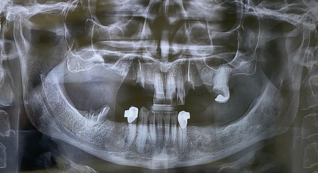 Riabilitazione Immediata Arcata Superiore - 1
