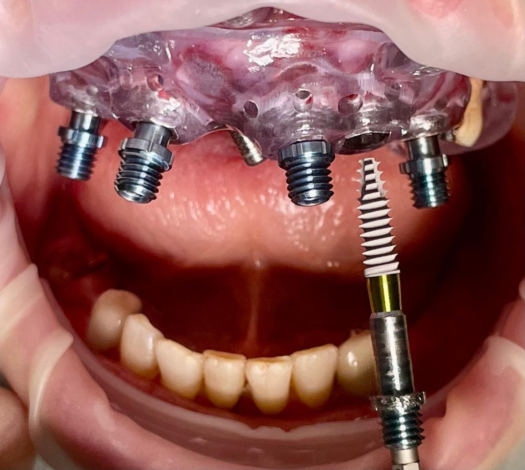 Riabilitazione Immediata Arcata Superiore - 10