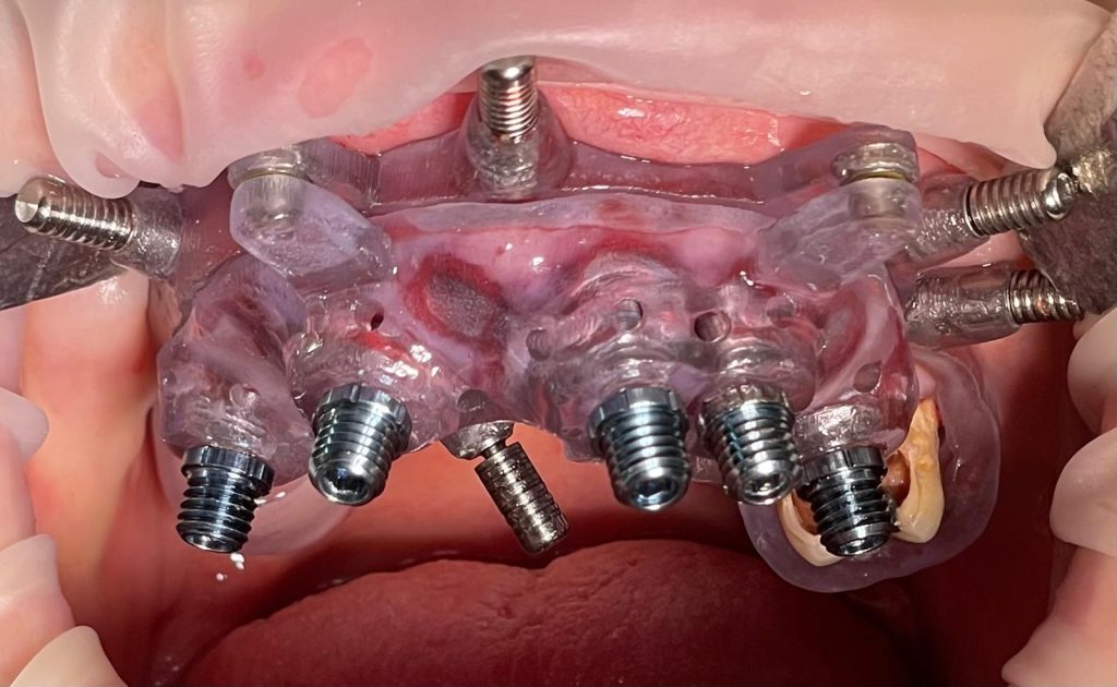 Riabilitazione Immediata Arcata Superiore - 11